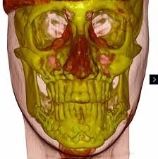 TAC VOLUMETRICA 3D - MEDIADENT SARZANA